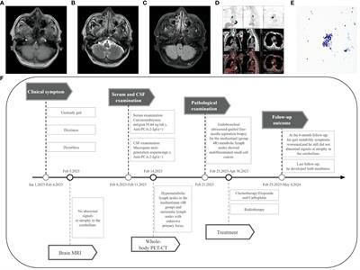 Case report: PCA-2-associated encephalitis with different clinical phenotypes: a two-case series and literature review